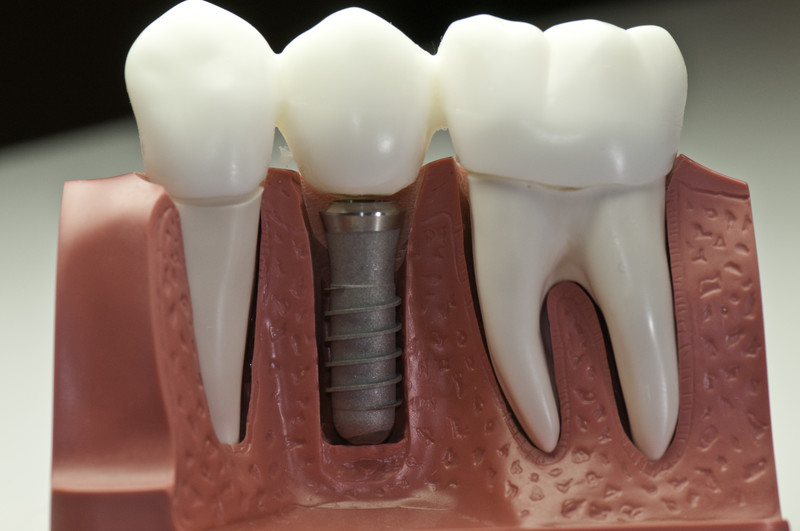 A close-up dental model shows a metal implant anchored in the jawbone beneath artificial teeth; stock model for education.